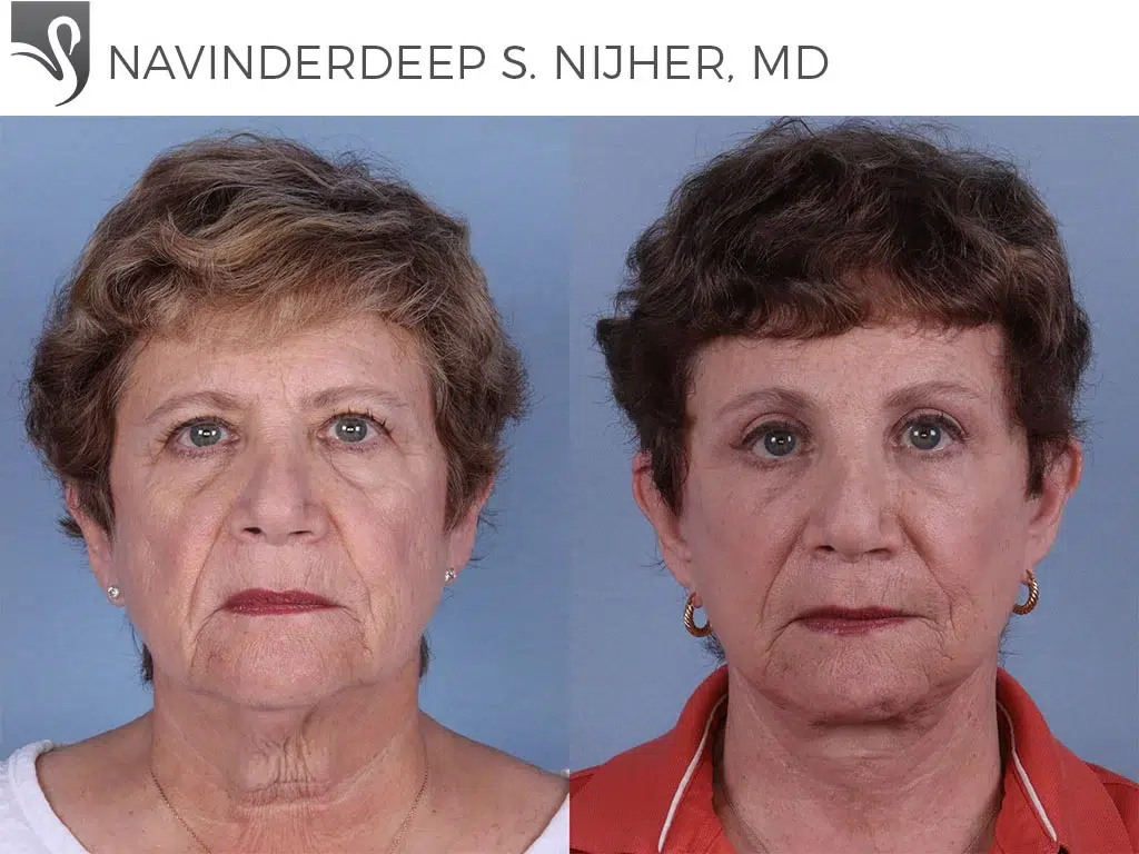 Before and After Image: Face Lift Case #60848 - front