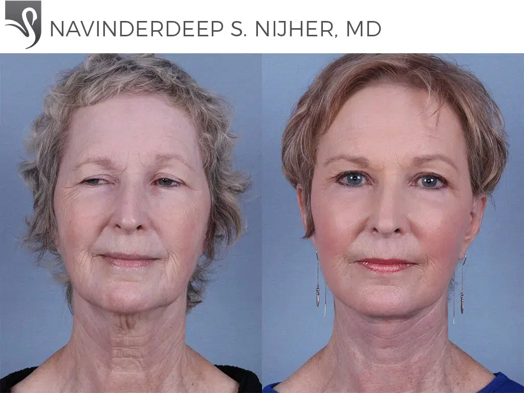 Before and After Image: Face Lift Case #60969 - front