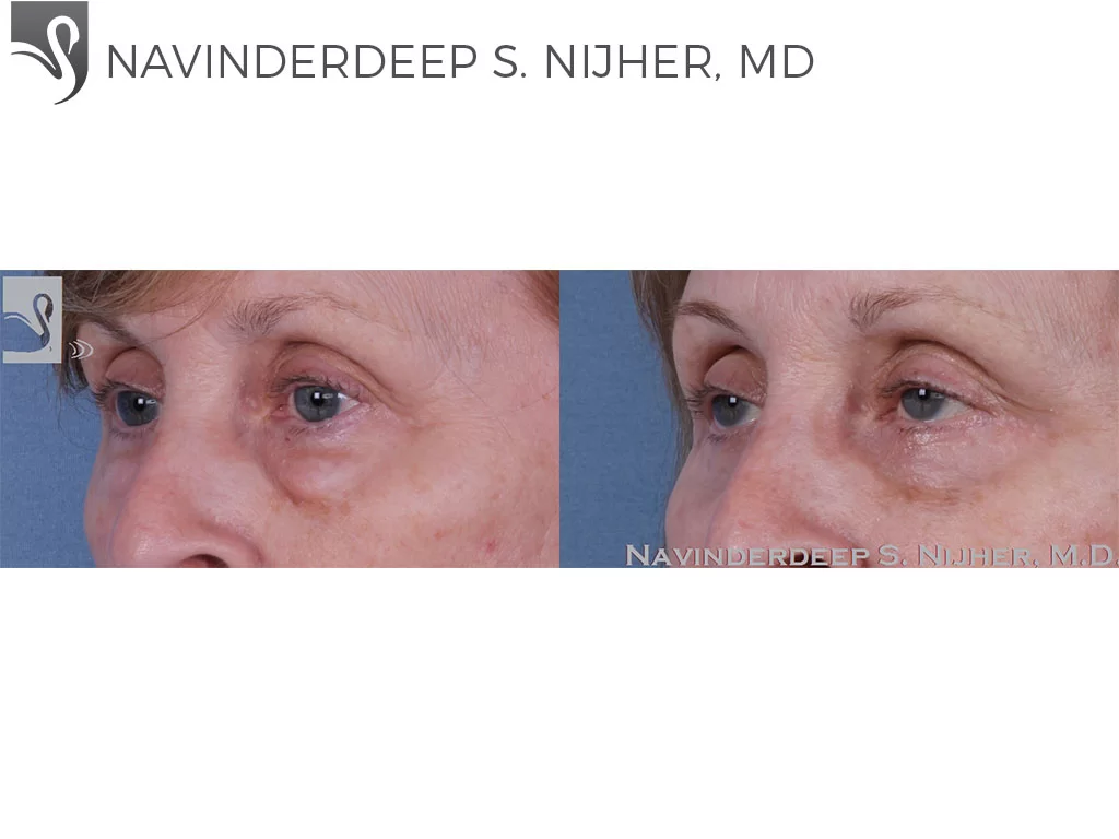 Before and After Image: Eyelid Surgery Case #61075 - left-front-oblique