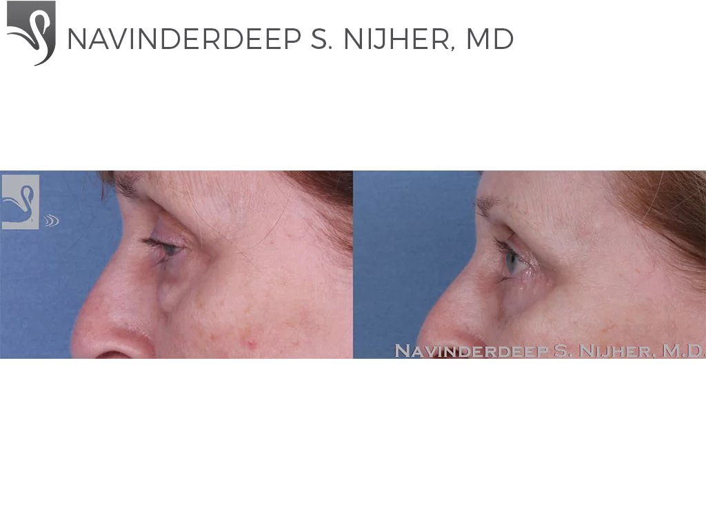 Before and After Image: Eyelid Surgery Case #61075 - left-side
