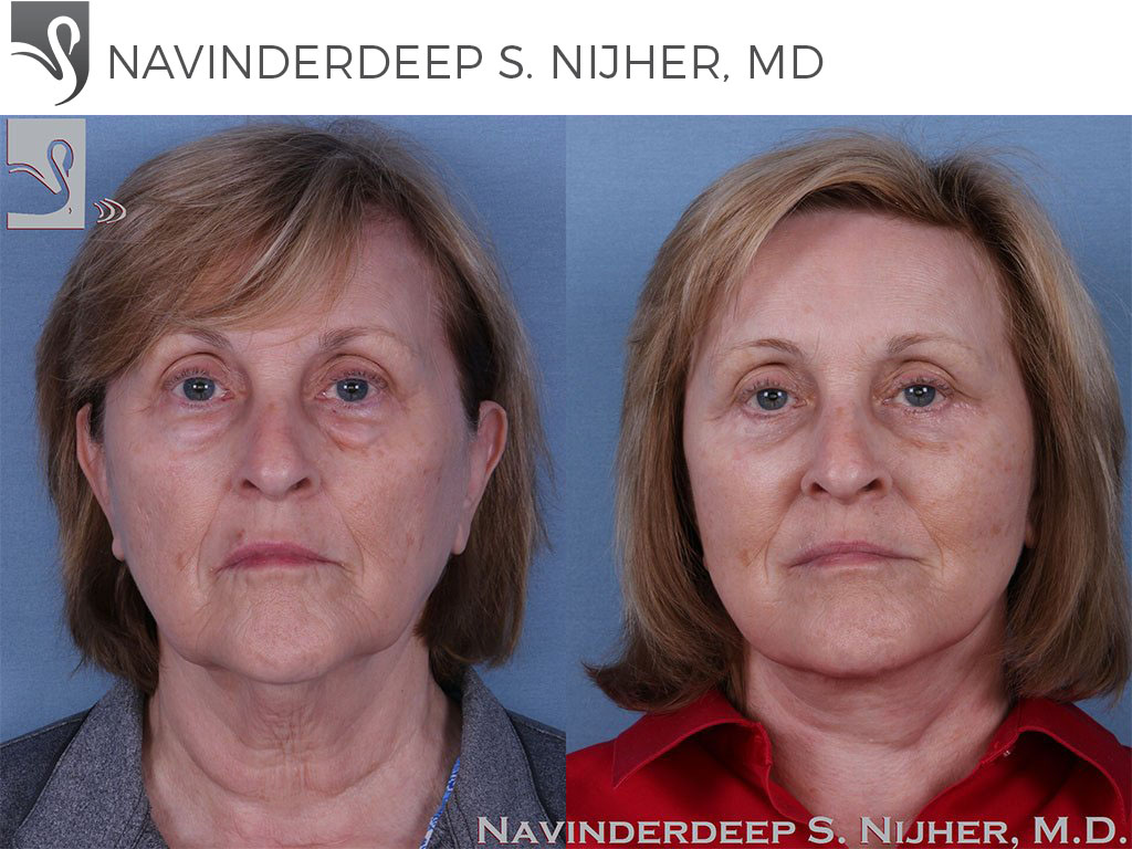 Before and After Image: Face Lift Case #61075 - front