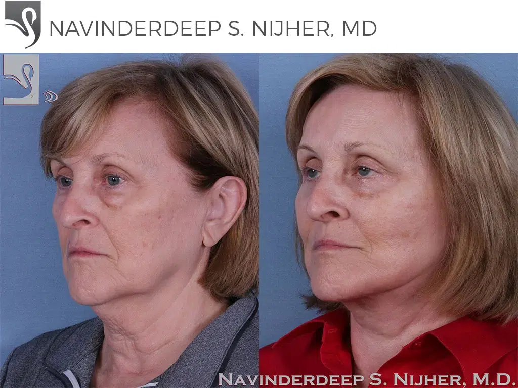 Before and After Image: Face Lift Case #61075 - left-front-oblique