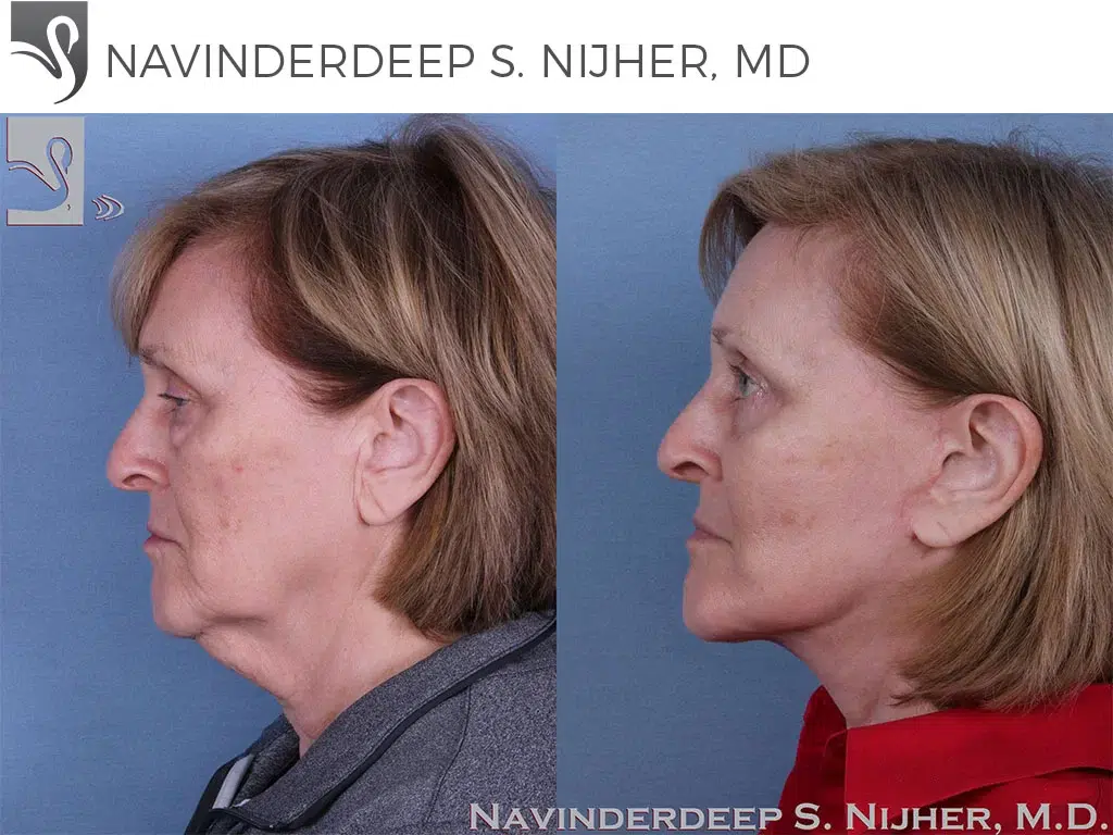 Before and After Image: Face Lift Case #61075 - left-side
