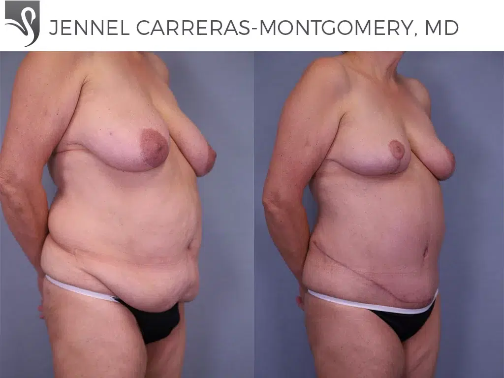 Before and After Image: Mommy Makeover Case #61273 - right-front-oblique