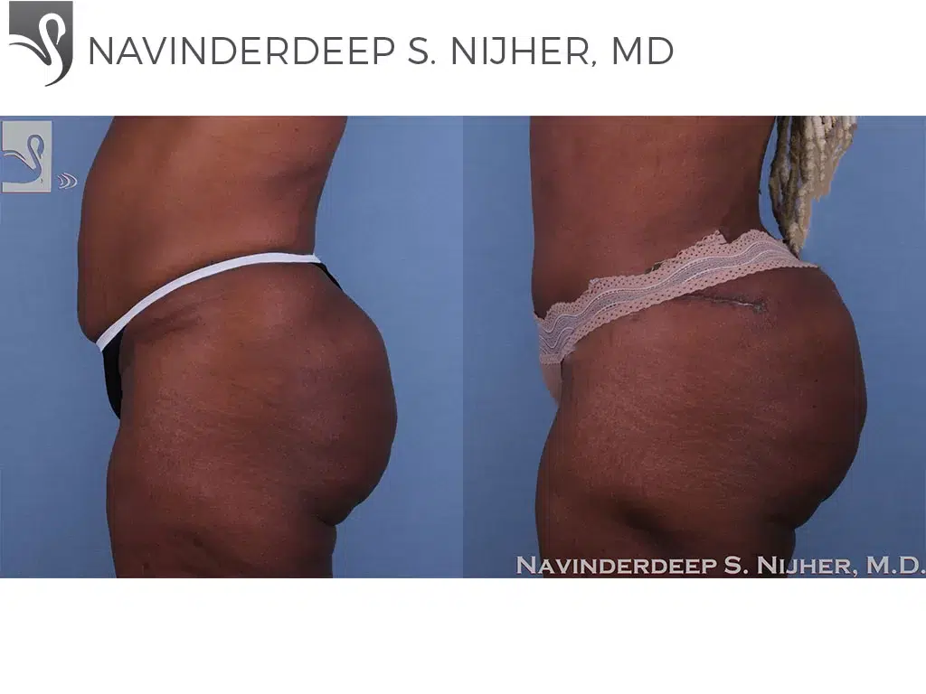 Before and After Image: Brazilian Butt Lift Case #61322 - left-side
