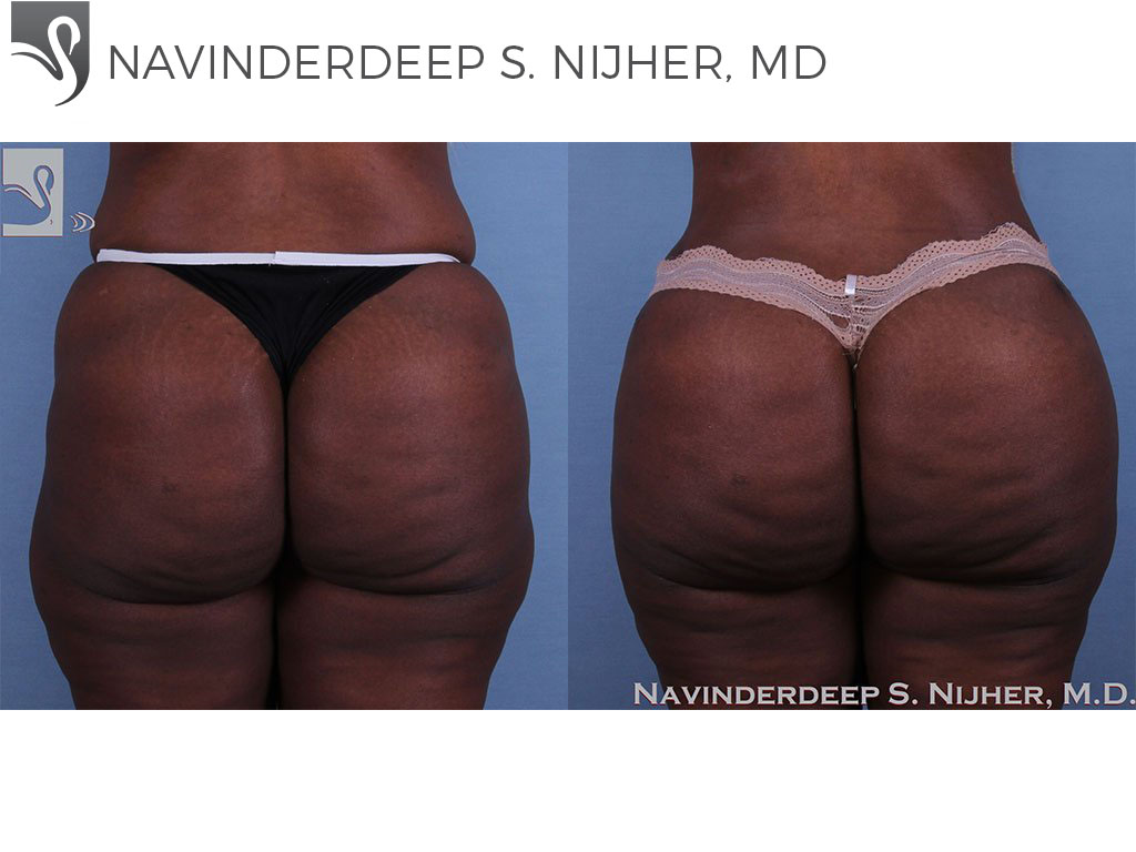 Before and After Image: Brazilian Butt Lift Case #61322
