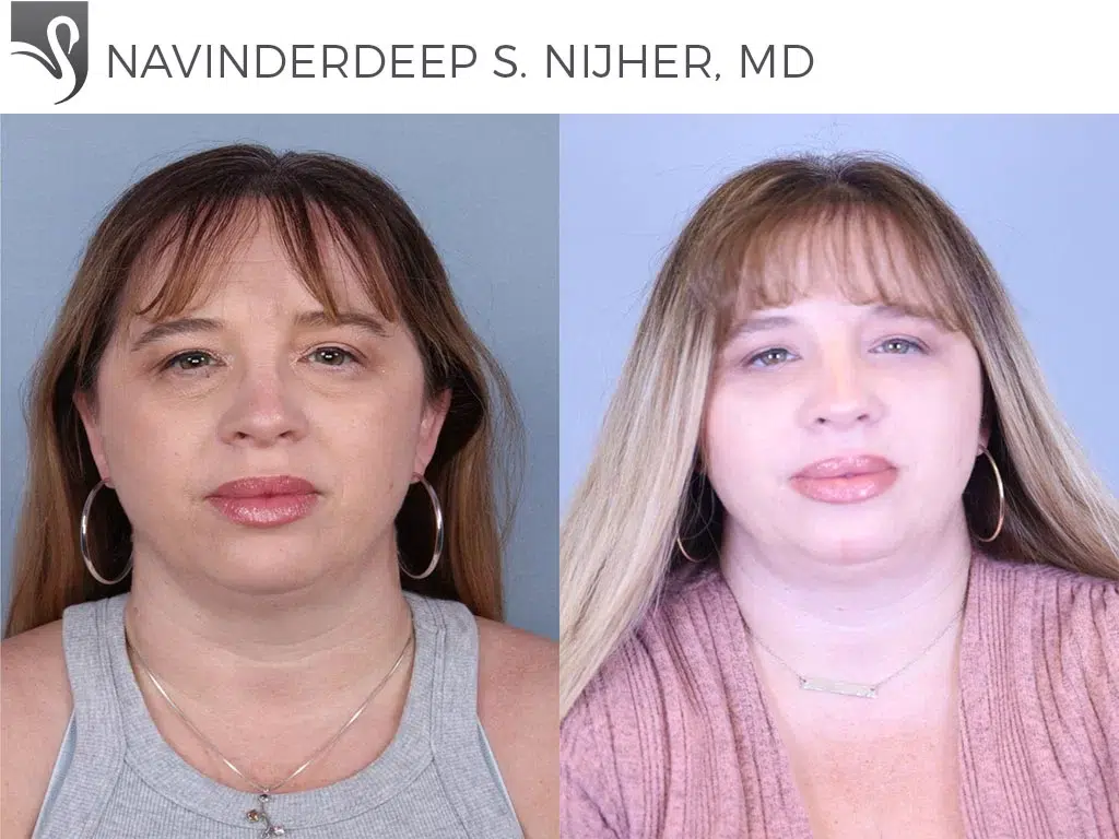 Before and After Image: Eyelid Surgery Case #61455 - front