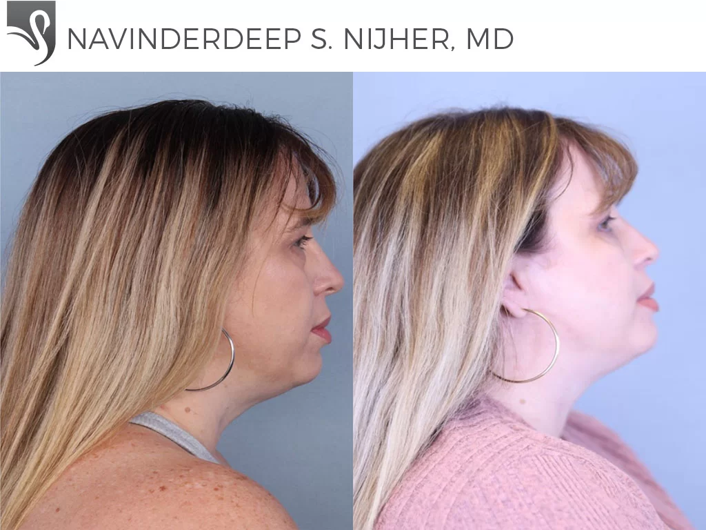 Before and After Image: Eyelid Surgery Case #61455 - right-side