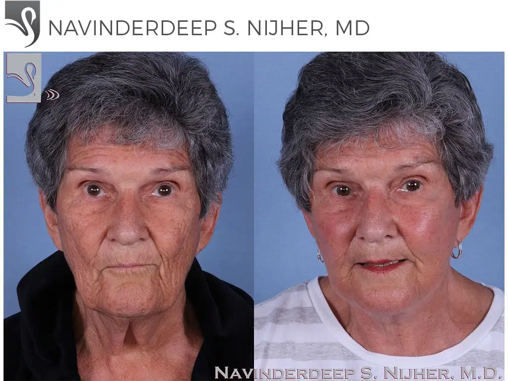 Before and After Image: Face Lift Case #61568 - front