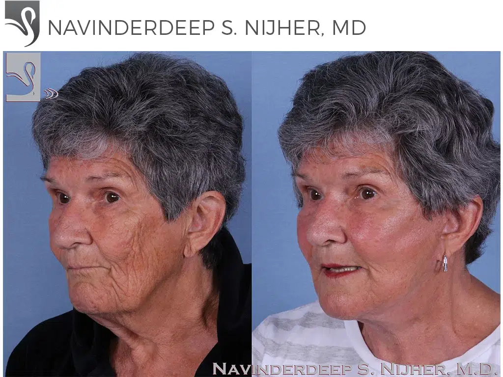 Before and After Image: Face Lift Case #61568 - left-front-oblique