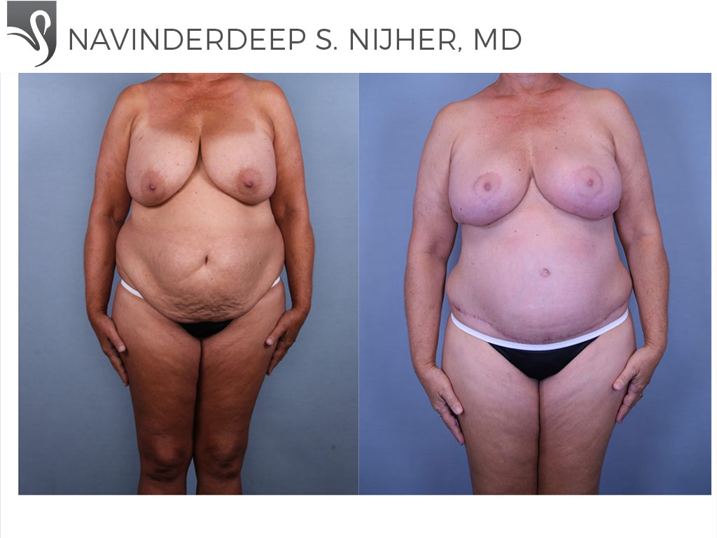 Before and After Image: Mommy Makeover Case #61612 - front