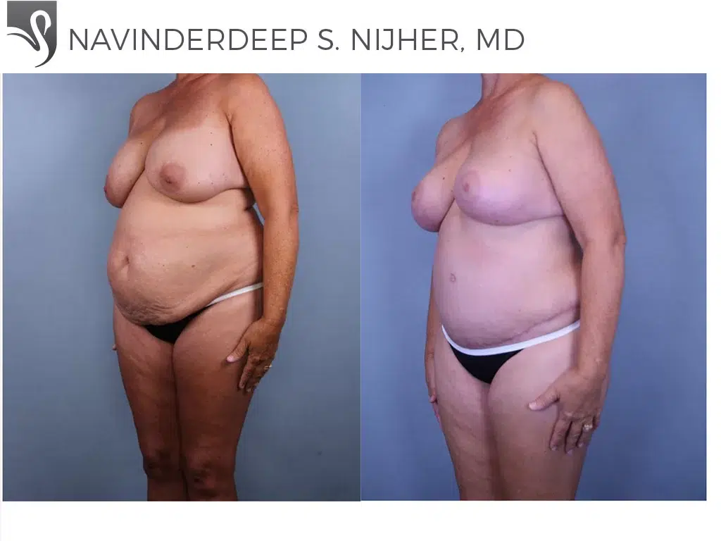 Before and After Image: Mommy Makeover Case #61612 - left-front-oblique
