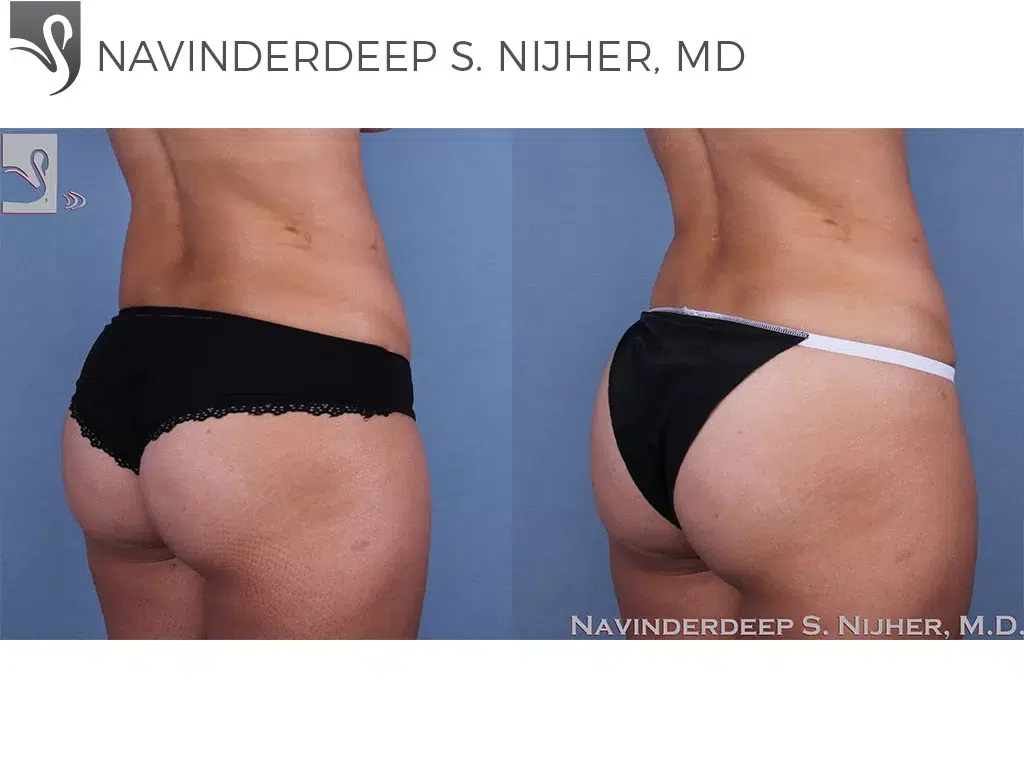 Before and After Image: Brazilian Butt Lift Case #61677 - right-back-oblique