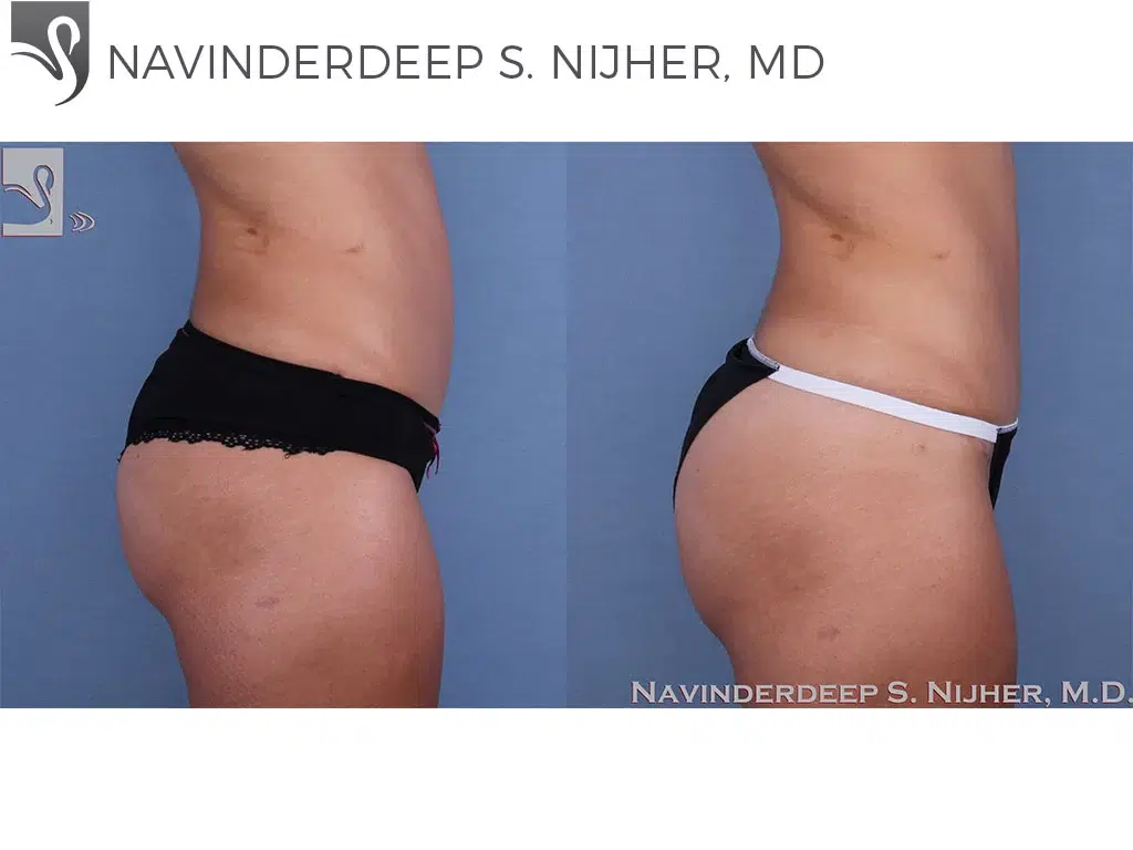 Before and After Image: Brazilian Butt Lift Case #61677 - right-side