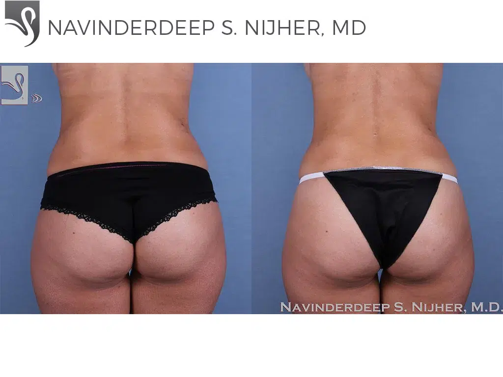 Before and After Image: Brazilian Butt Lift Case #61677 - back