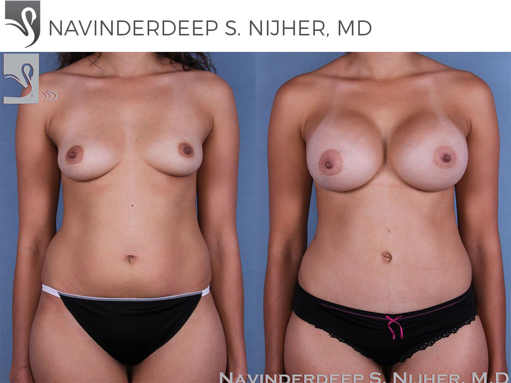 Before and After Image: Mommy Makeover Case #61677 - front