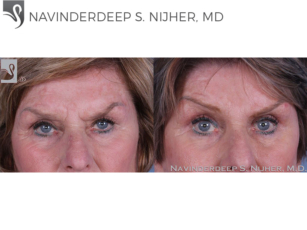 Before and After Image: Eyelid Surgery Case #62120 - front