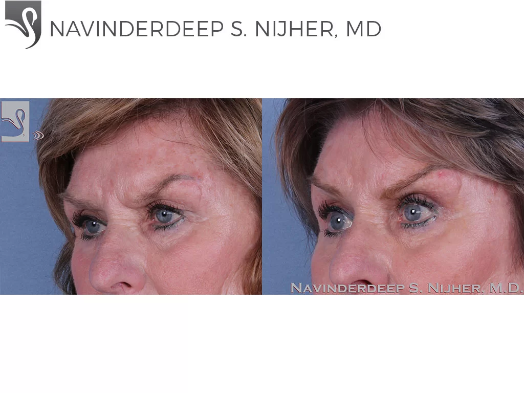Before and After Image: Eyelid Surgery Case #62120 - left-front-oblique