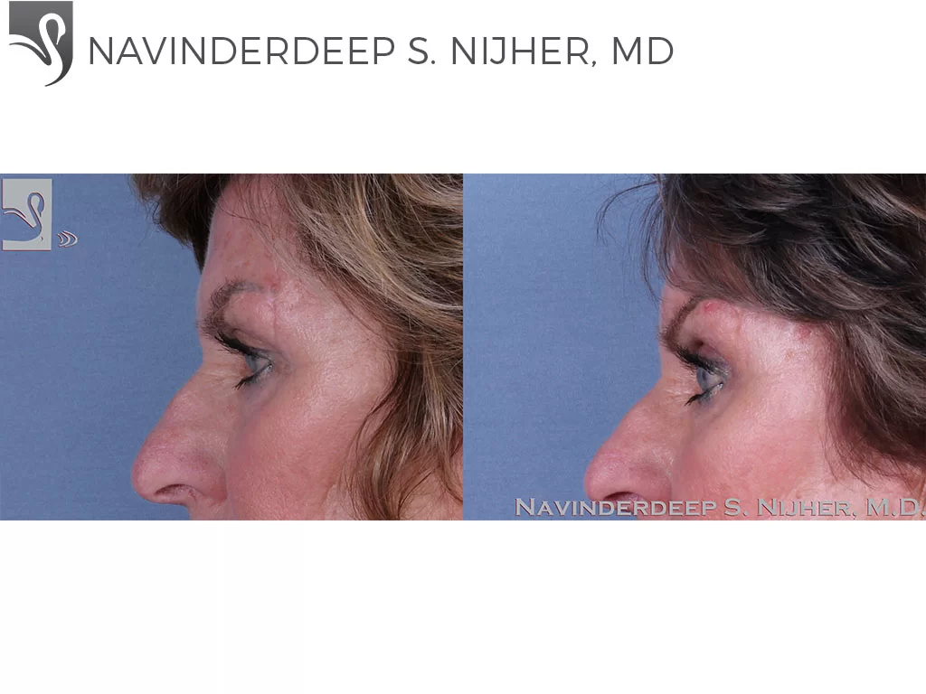 Before and After Image: Eyelid Surgery Case #62120 - left-side