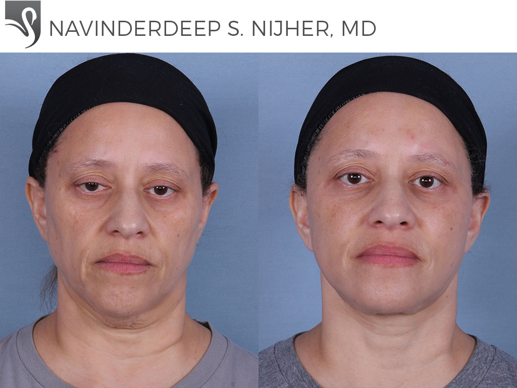 Before and After Image: Face Lift Case #62230 - front