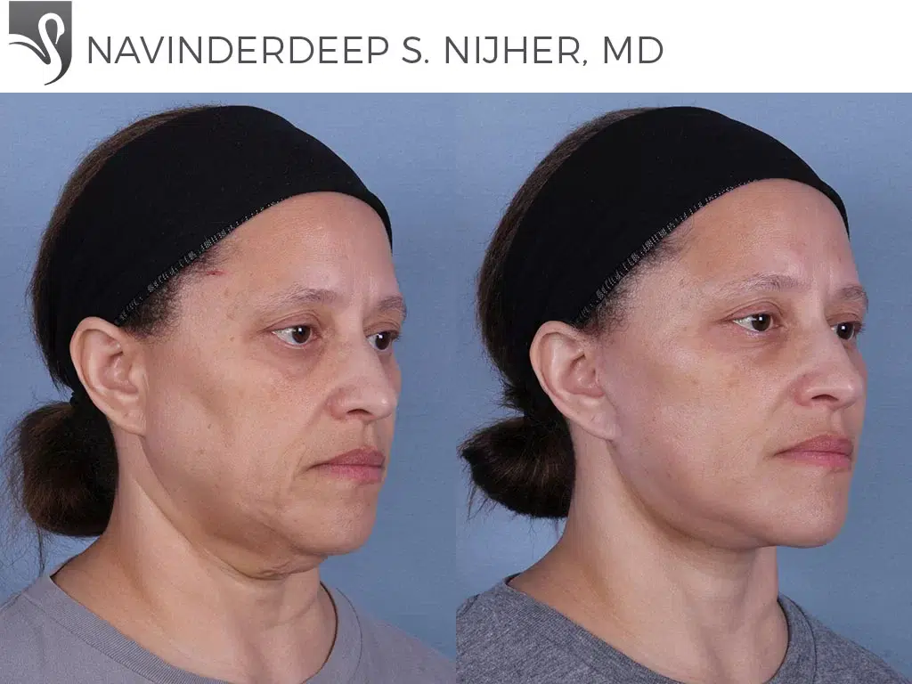 Before and After Image: Face Lift Case #62230 - right-front-oblique
