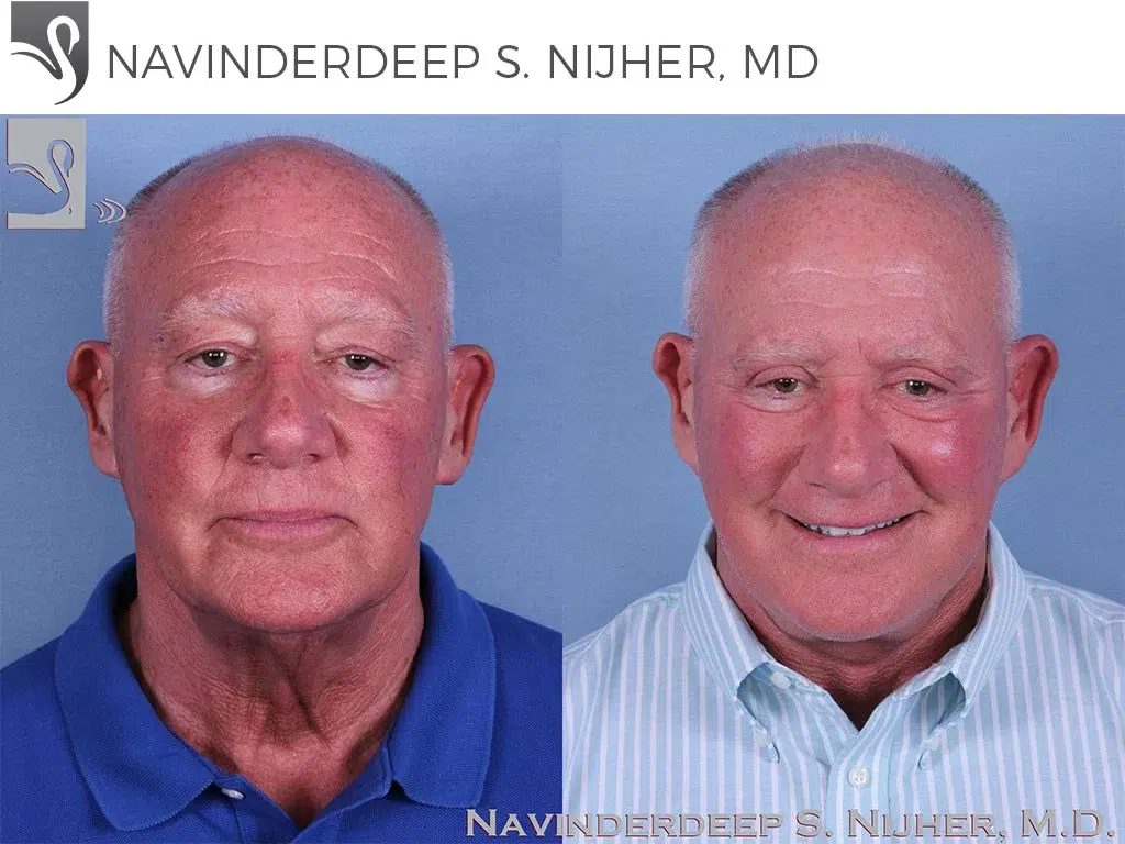 Before and After Image: Face Lift Case #62249 - front