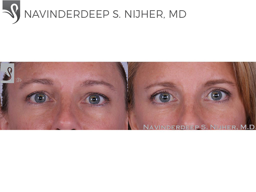 Before and After Image: Eyelid Surgery Case #62268 - front