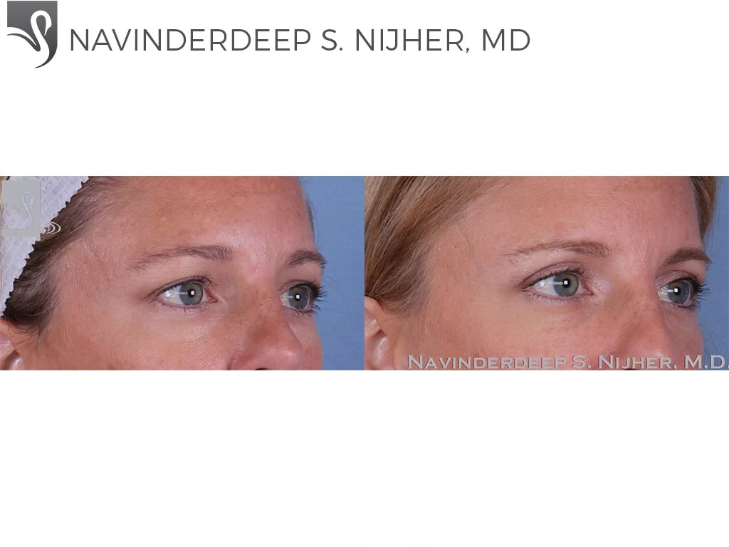 Before and After Image: Eyelid Surgery Case #62268 - right-front-oblique