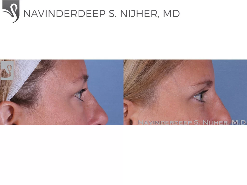 Before and After Image: Eyelid Surgery Case #62268 - right-side