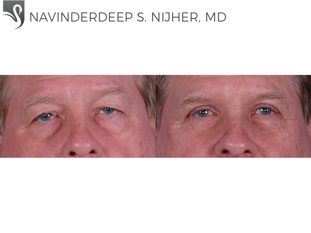 Before and After Image: Eyelid Surgery Case #62816 - front