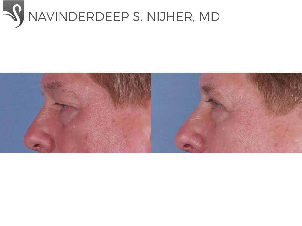Before and After Image: Eyelid Surgery Case #62816 - left-side