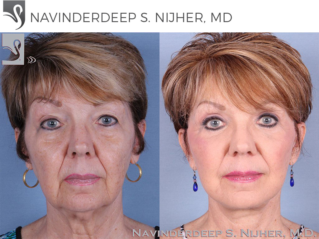 Before and After Image: Face Lift Case #62997 - front