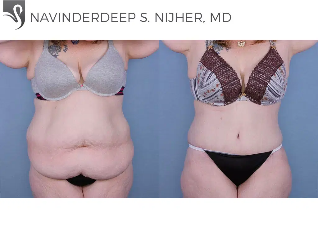 Before and After Image: Abdominoplasty (Tummy Tuck) Case #63451 - front