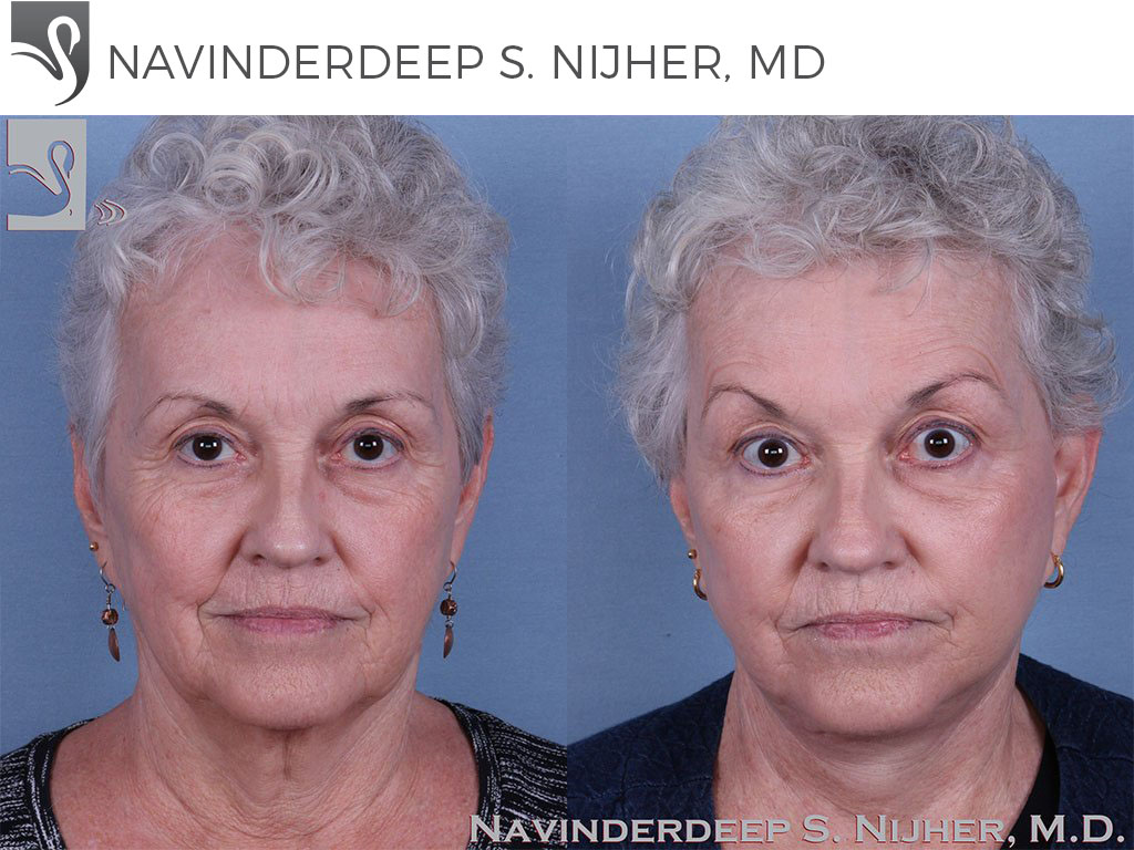 Before and After Image: Face Lift Case #63607 - front