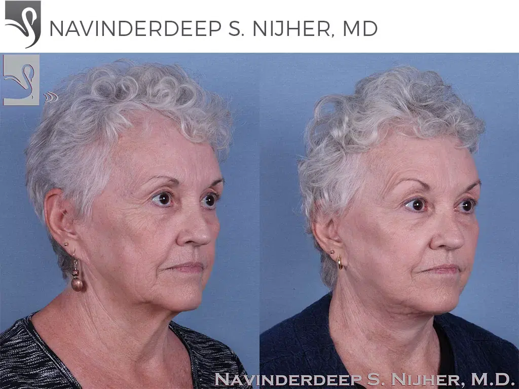 Before and After Image: Face Lift Case #63607 - right-front-oblique