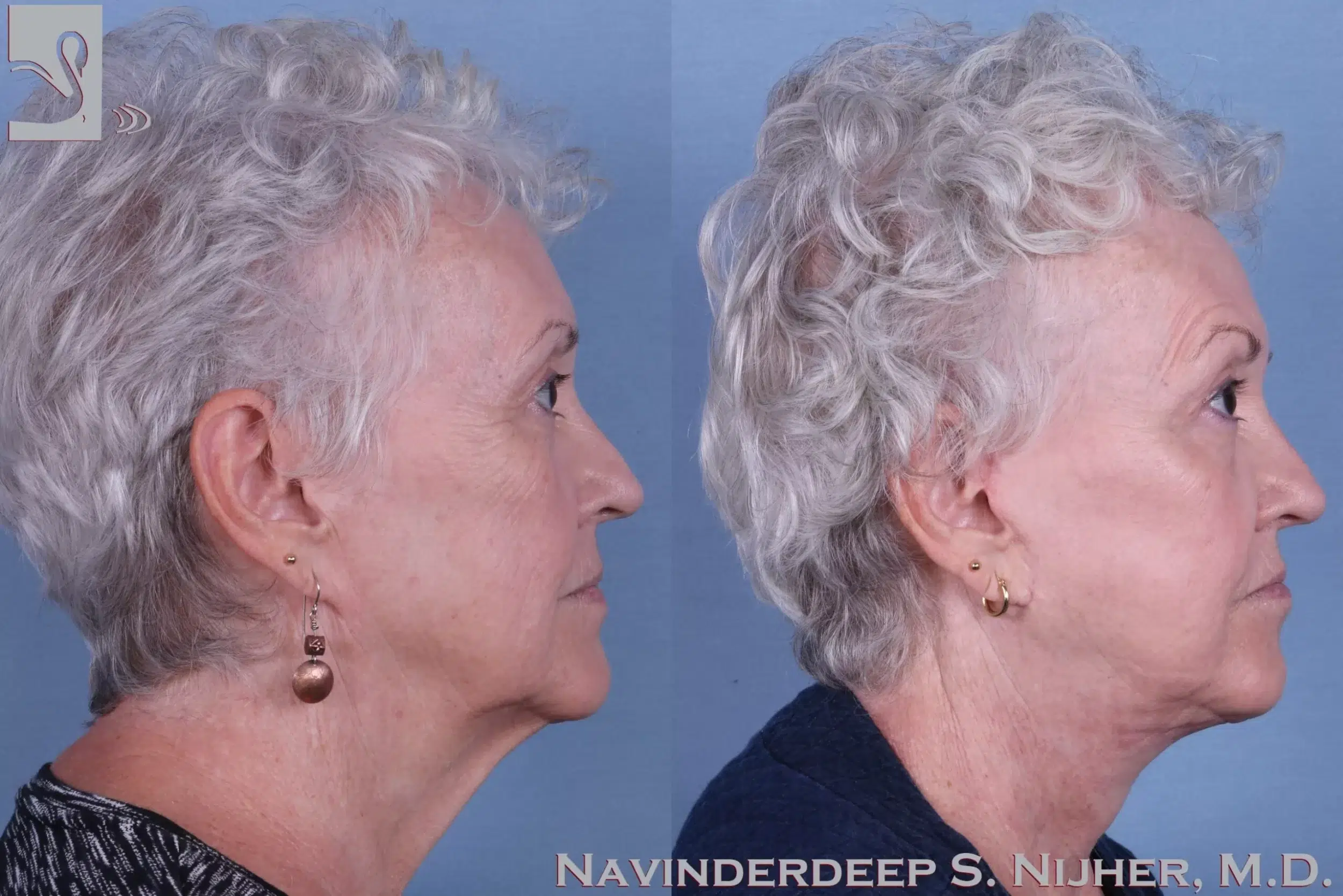 Before and After Image: Face Lift Case #63607 - right-side