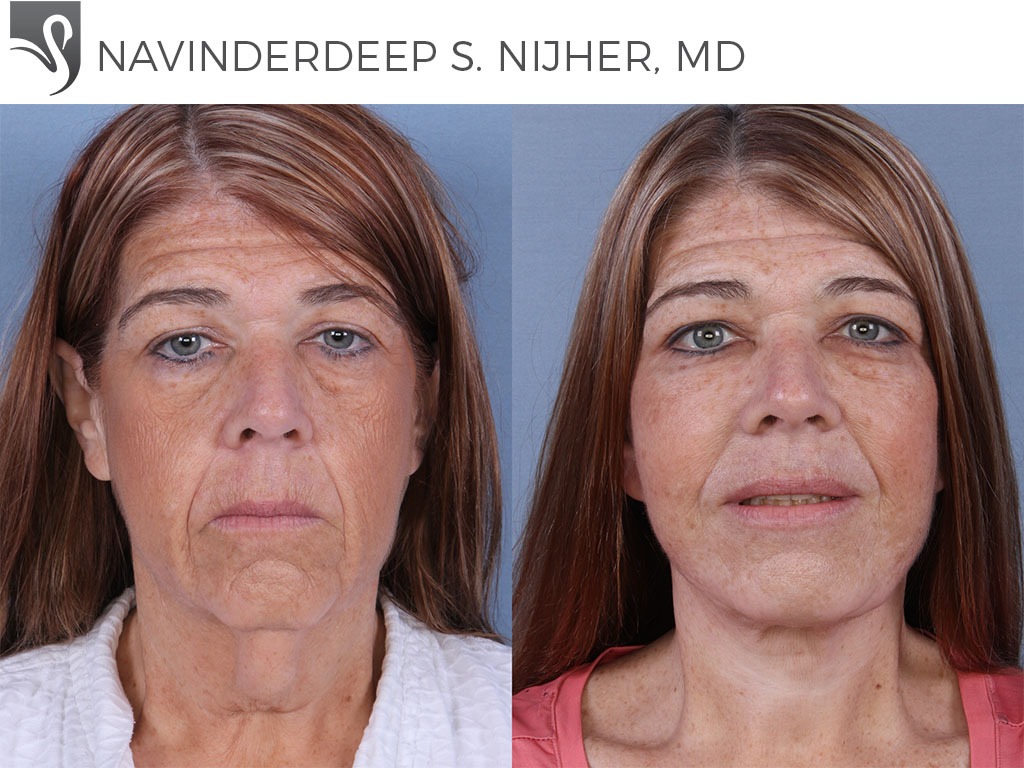 Before and After Image: Face Lift Case #63669 - front