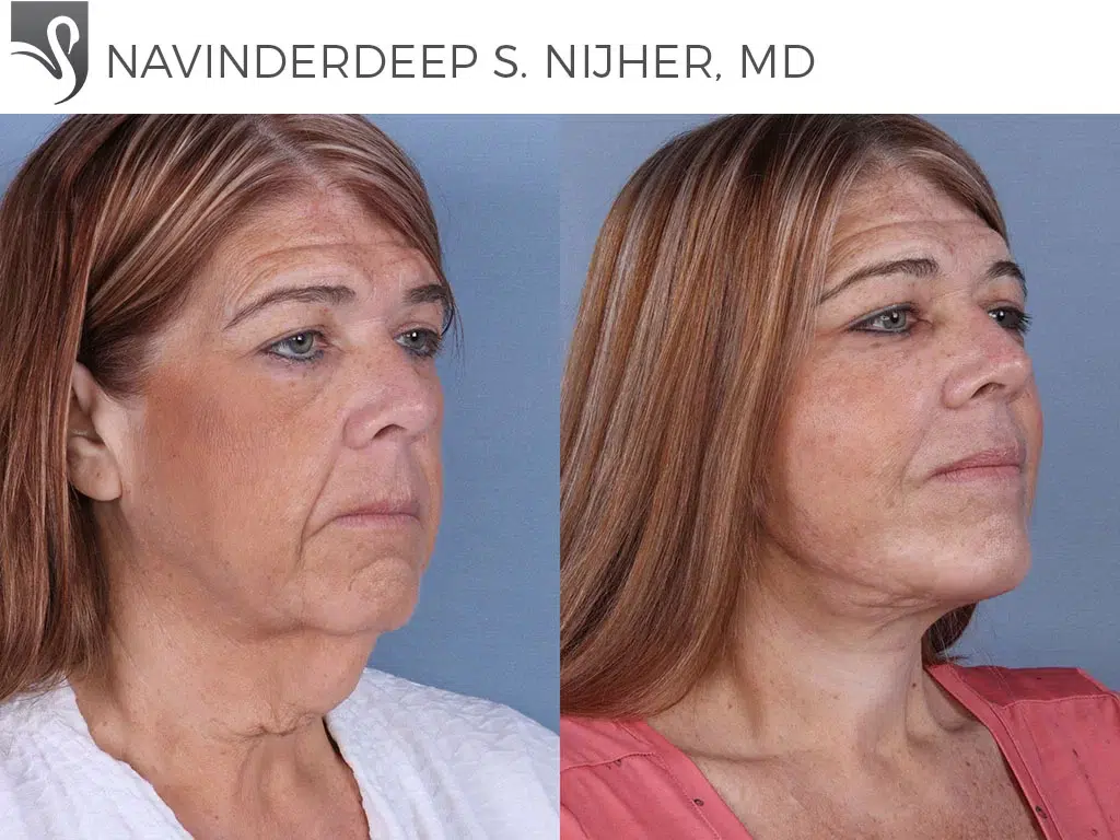 Before and After Image: Face Lift Case #63669 - right-front-oblique