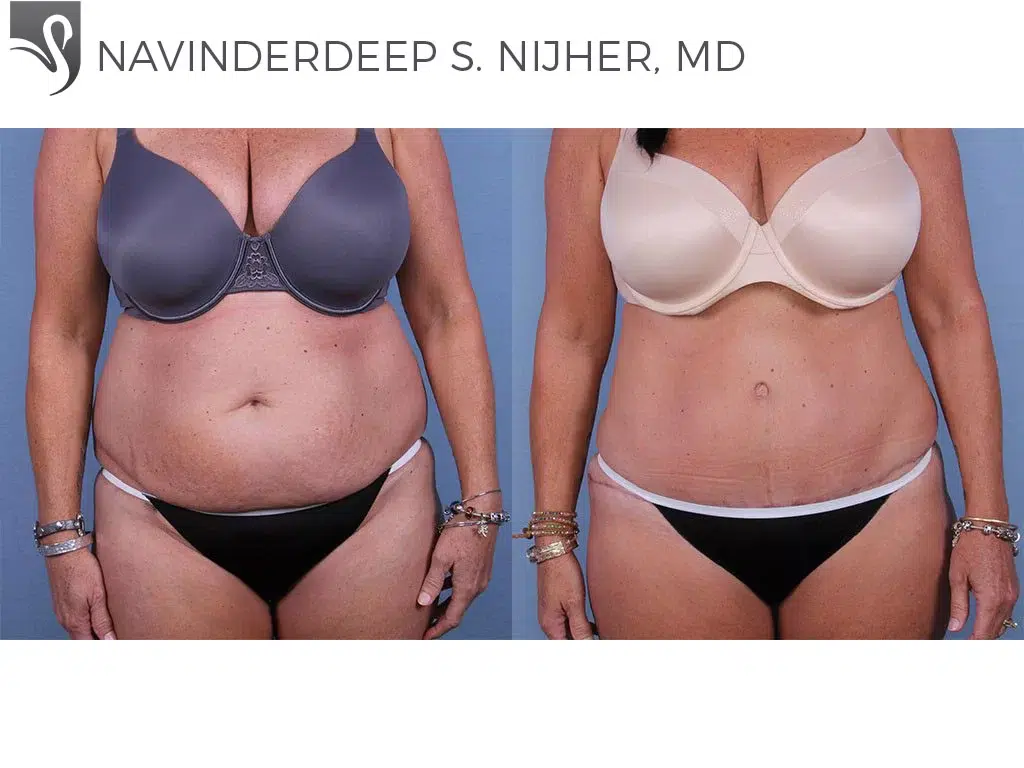 Before and After Image: Abdominoplasty (Tummy Tuck) Case #63754 - front