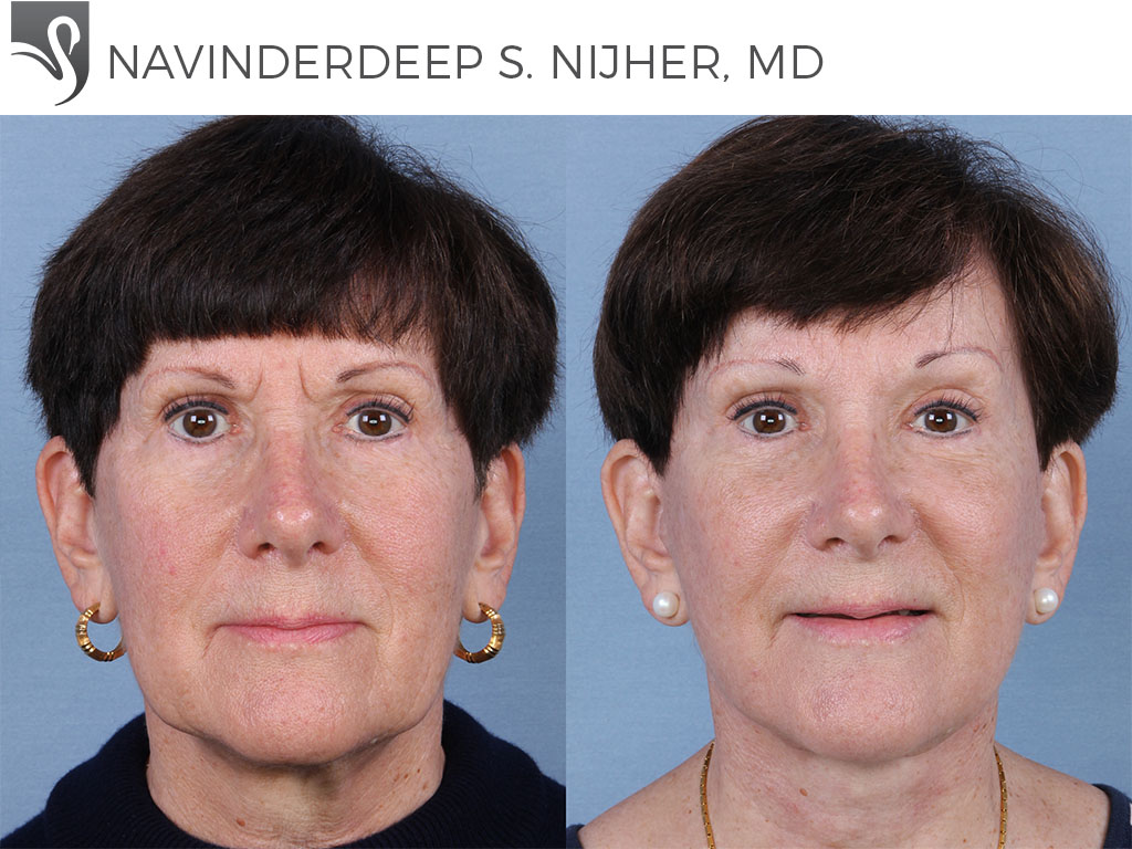 Before and After Image: Face Lift Case #64127 - front
