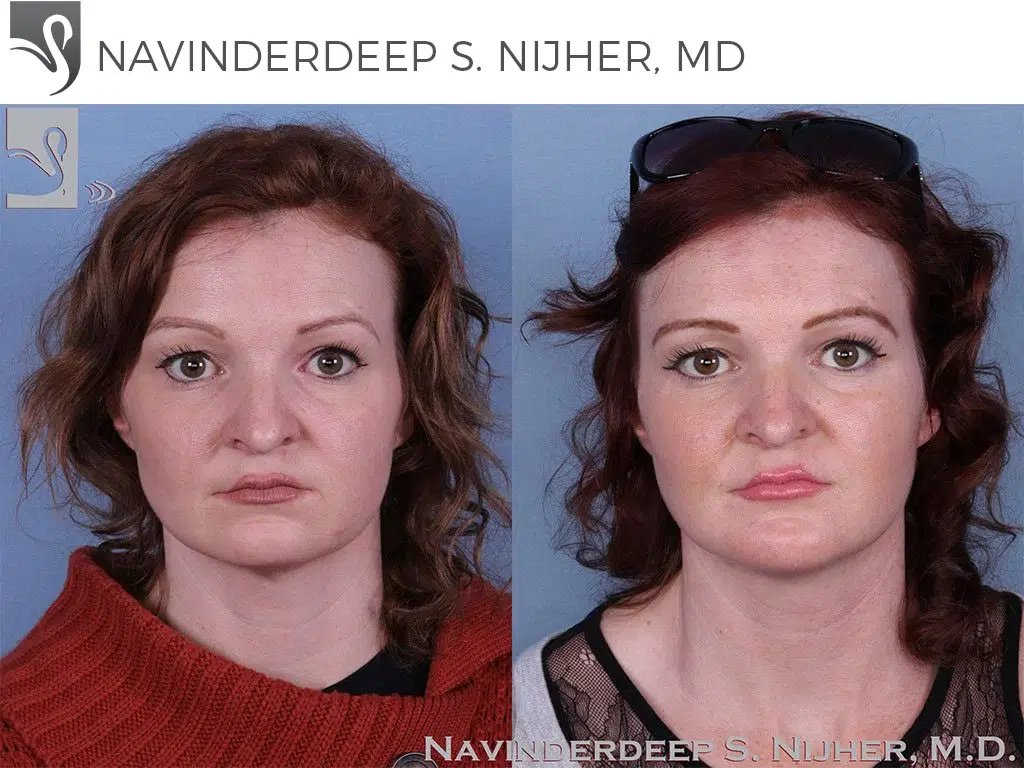 Before and After Image: Facial Implants Case #64206 - front