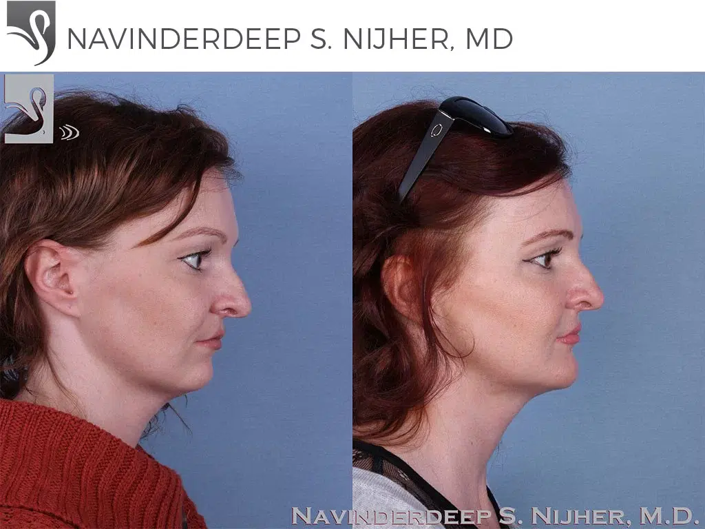 Before and After Image: Facial Implants Case #64206 - right-side