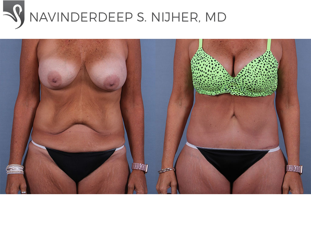 Before and After Image: Abdominoplasty (Tummy Tuck) Case #64217 - front