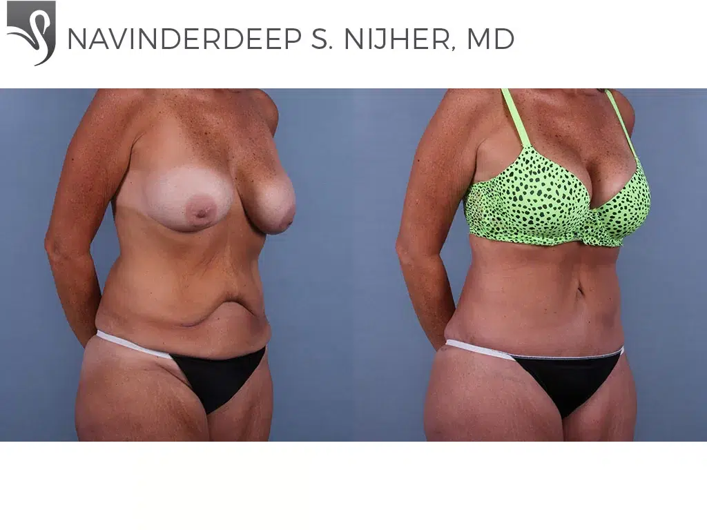 Before and After Image: Abdominoplasty (Tummy Tuck) Case #64217 - right-front-oblique