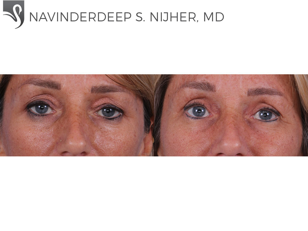Before and After Image: Eyelid Surgery Case #64217 - front