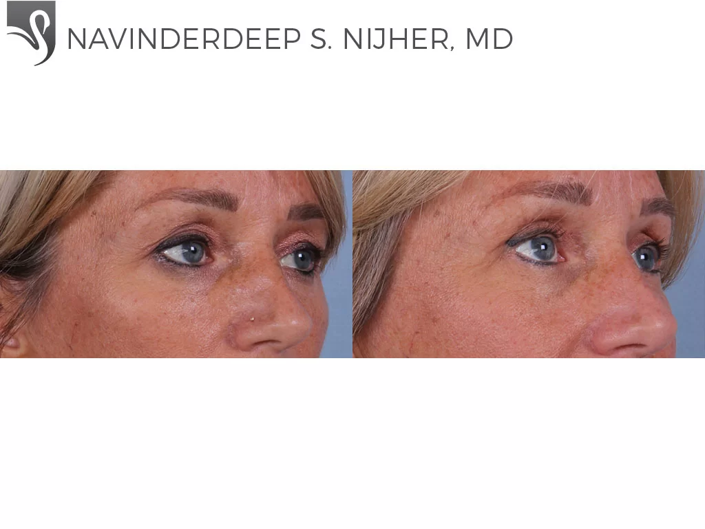 Before and After Image: Eyelid Surgery Case #64217 - right-front-oblique