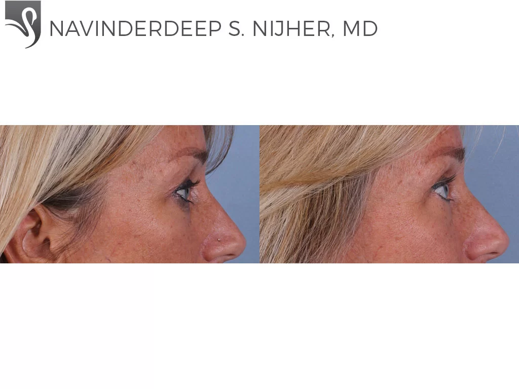 Before and After Image: Eyelid Surgery Case #64217 - right-side
