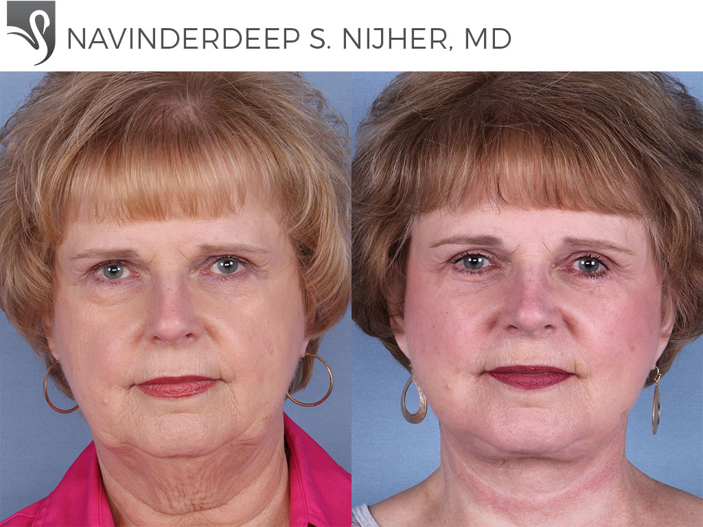 Before and After Image: Face Lift Case #65421 - front