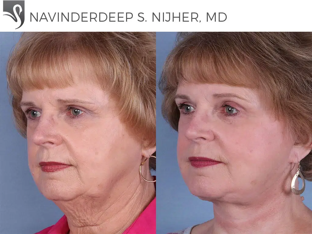 Before and After Image: Face Lift Case #65421 - left-front-oblique