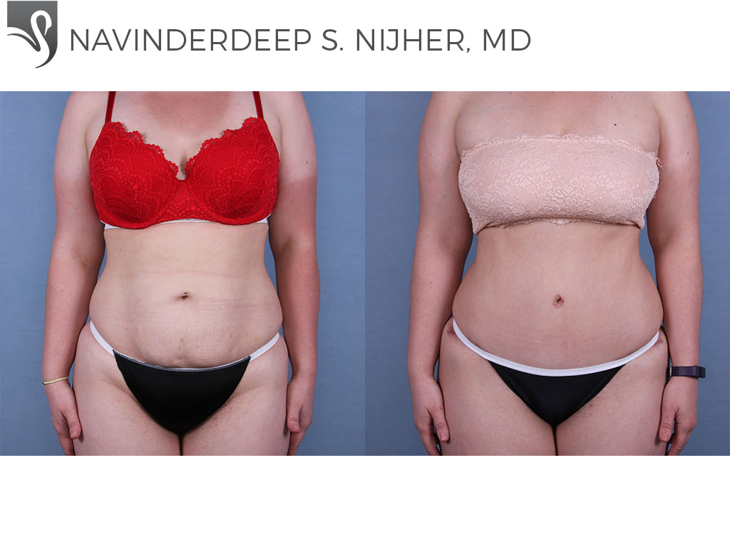 Before and After Image: Abdominoplasty (Tummy Tuck) Case #64393 - front
